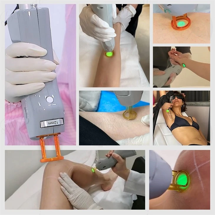 Cynosure 1064nm 755nm Alexandrite Laser Hair Removal Machine